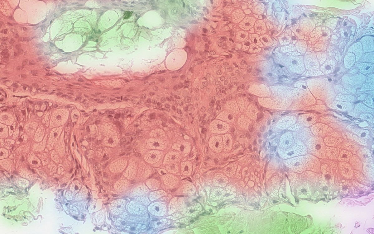 HistoFrame AI cancer detection — colored zones showing Squamous-cell, Adenocarcinoma, Benign stroma classification